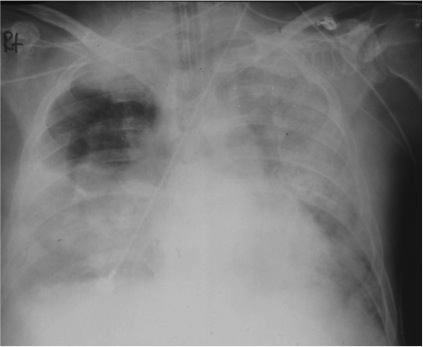 lung xray - acute respiratory distress syndrome