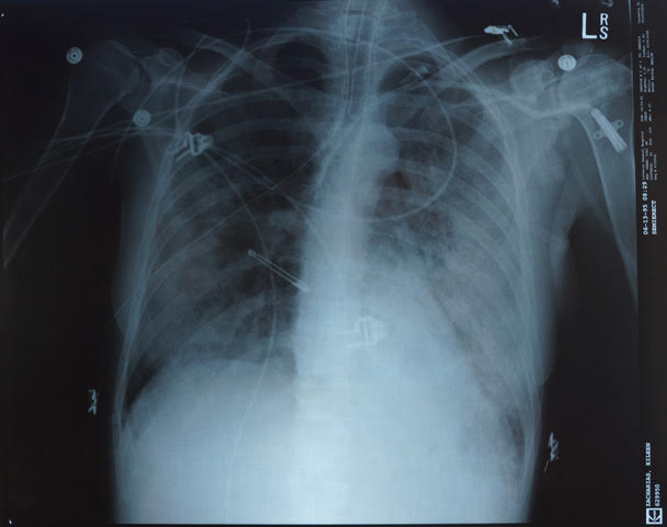 xray of patient with ARDS